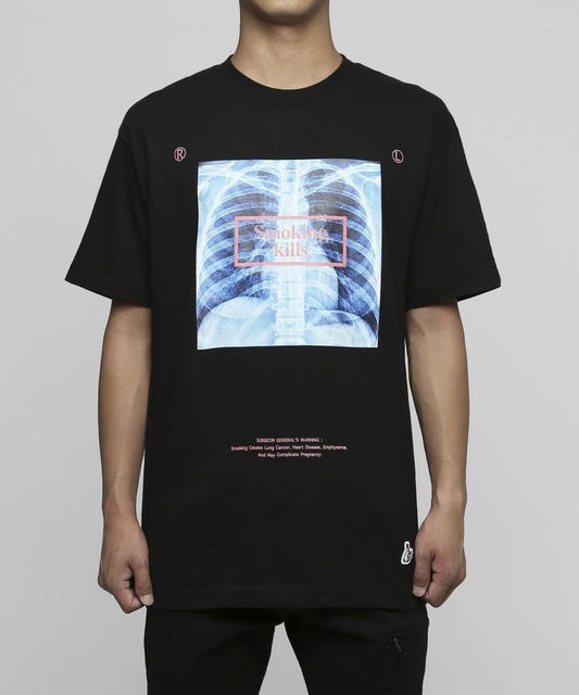 #FR2 x Lung Cancer